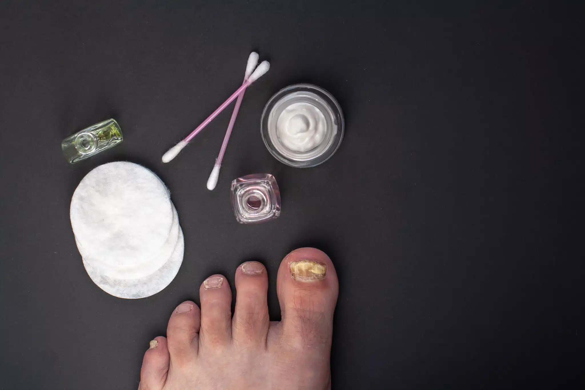 4 Traitements Naturels Mycose Pieds et Ongles | Santé Pied